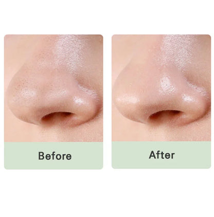 Pore & Oily skin Treatment (Offer )