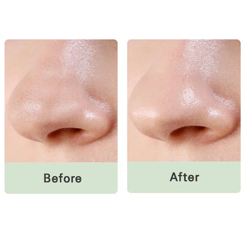 Pore & Oily skin Treatment (Offer )