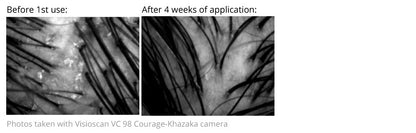 شامبو علاج القشرة واكزيما فروة الرأس 200 مل من ديرمينا